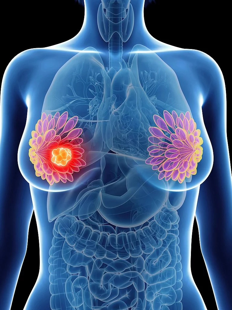 3d gerenderte medizinisch genaue Illustration einer Frau mit Brustdrüsenkrebs