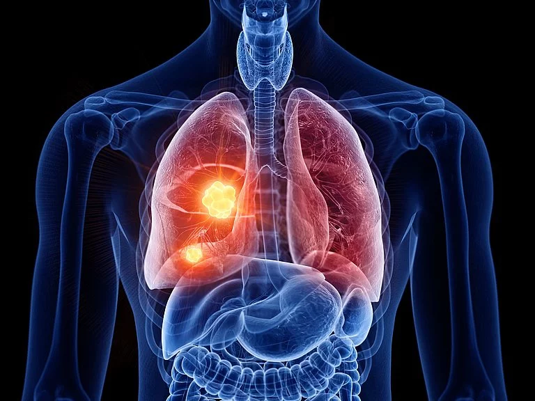 3d gerenderte, medizinisch korrekte Darstellung von Lungenkrebs