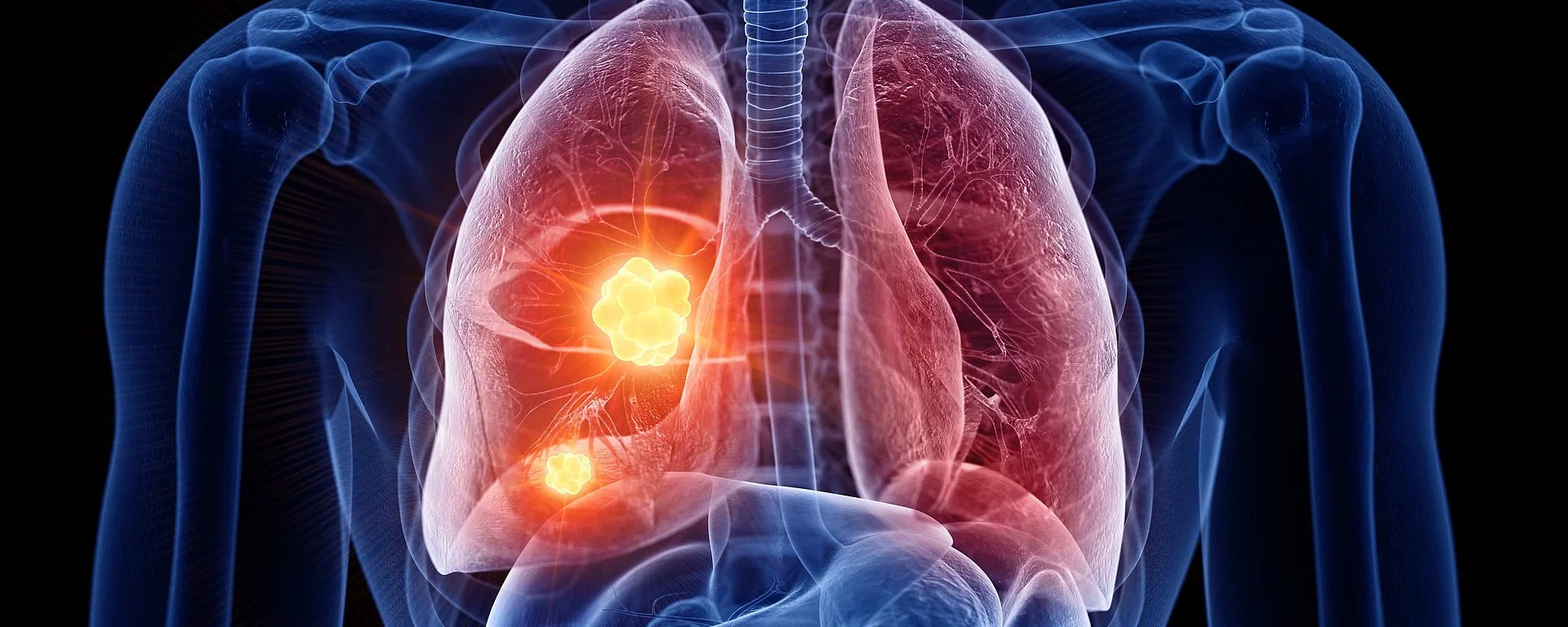 3d gerenderte, medizinisch korrekte Darstellung von Lungenkrebs
